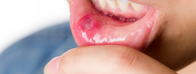 Unlock the Healing Power of Manuka Honey and Oil: Natural Remedies for Mouth Ulcers